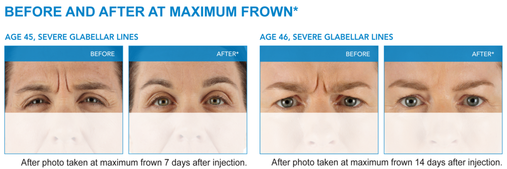 before and after Xeomin Neurotoxin Injections