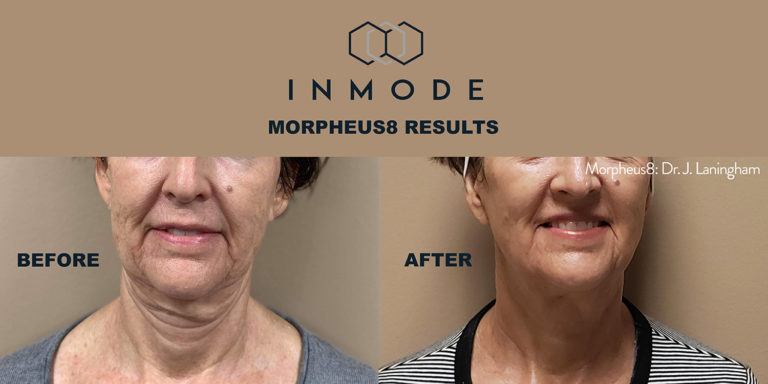 inmode Morpheus8 before and after